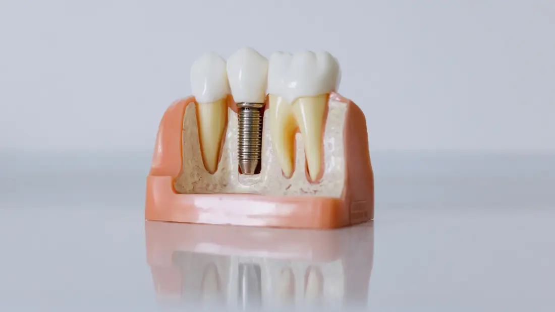 Da li je ugradnja dentalnog implantata bolna?