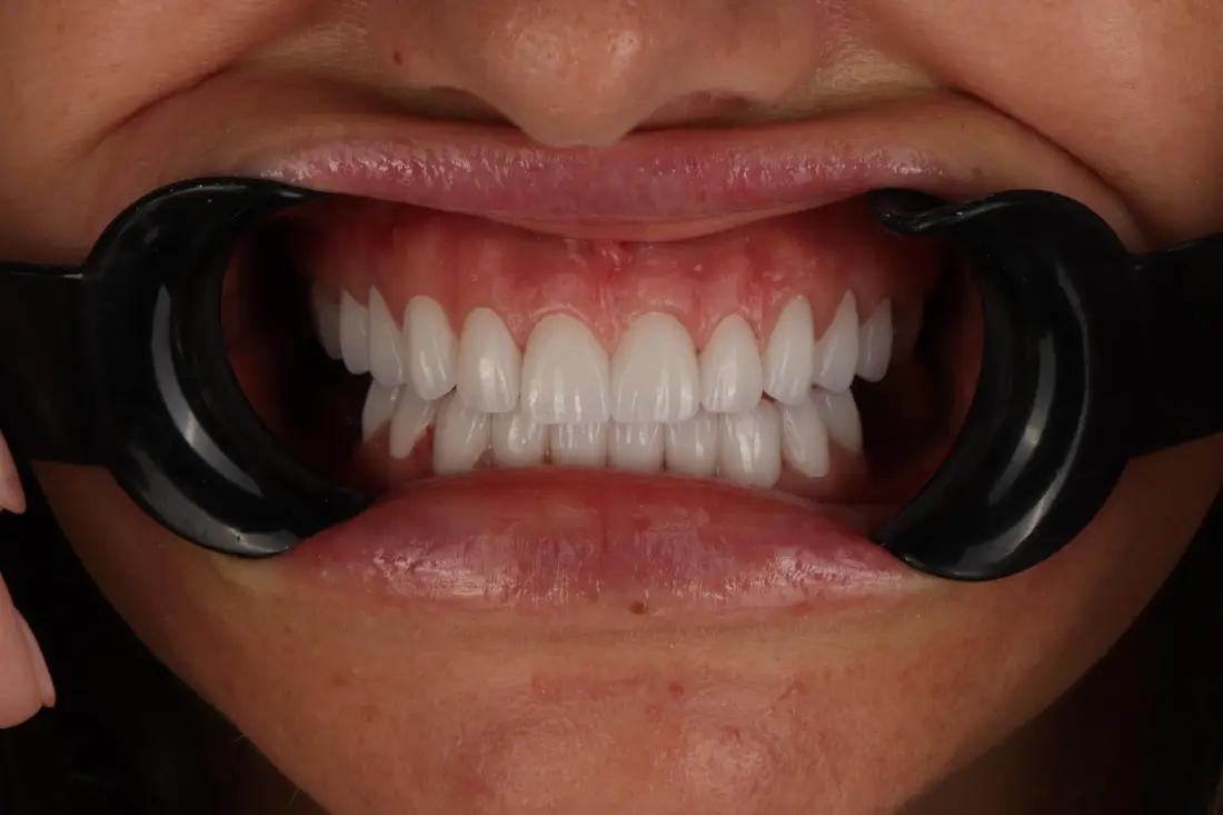 Stomatološka protetika u Family Dental Centru